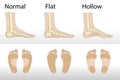 Hollow, flat, and normal foot. medical disease infographics.